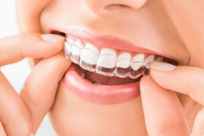 invisible braces in hyderabad