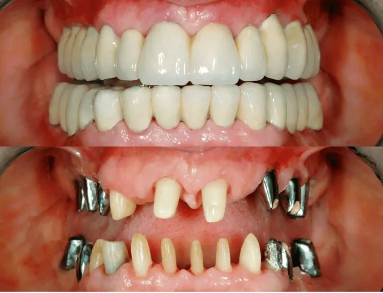 Full Mouth Reconstruction