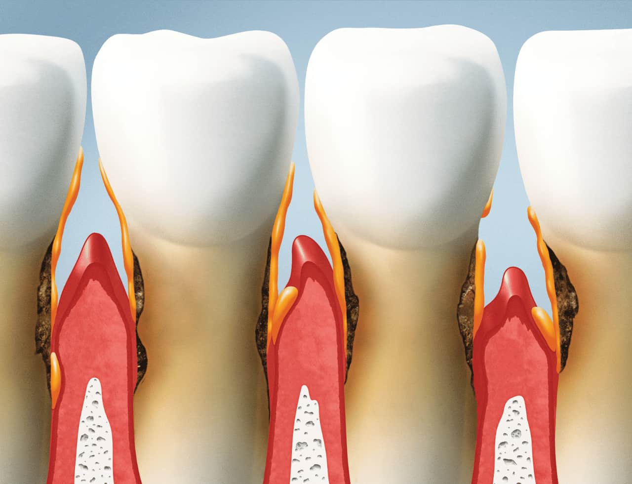 Gum Surgery at Smilebook Dental Hyderabad