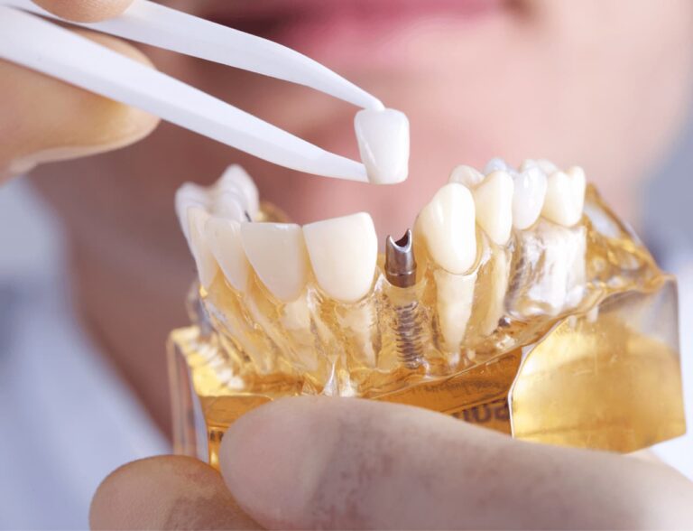 Find Best Implant Dentist in Hyderabad