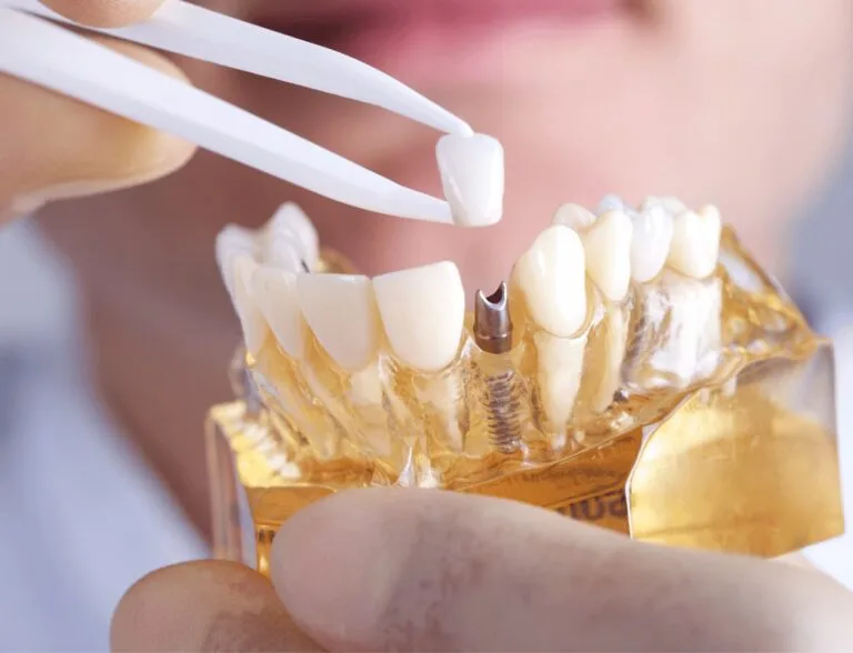 Best Implant Dentist in Hyderabad