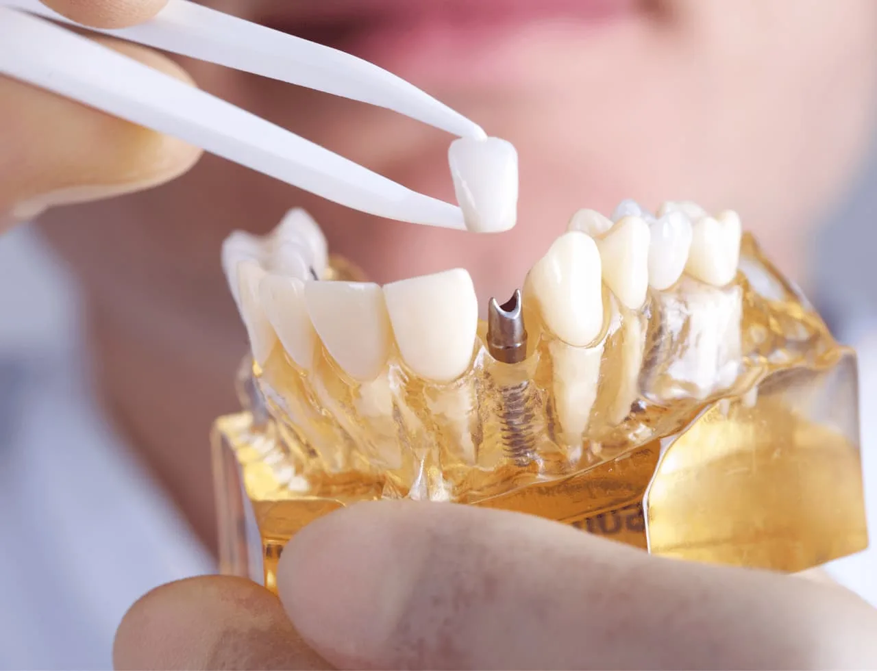 Best Implant Dentist in Hyderabad