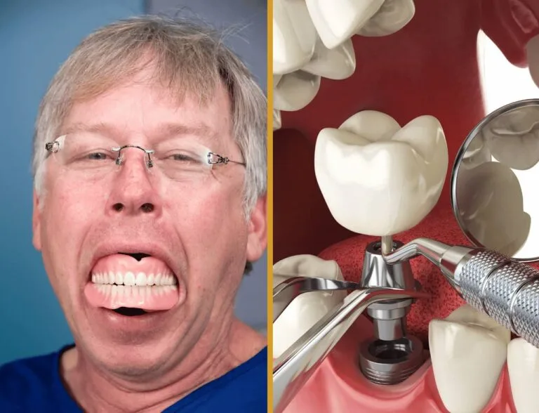 All on 4 dental implants