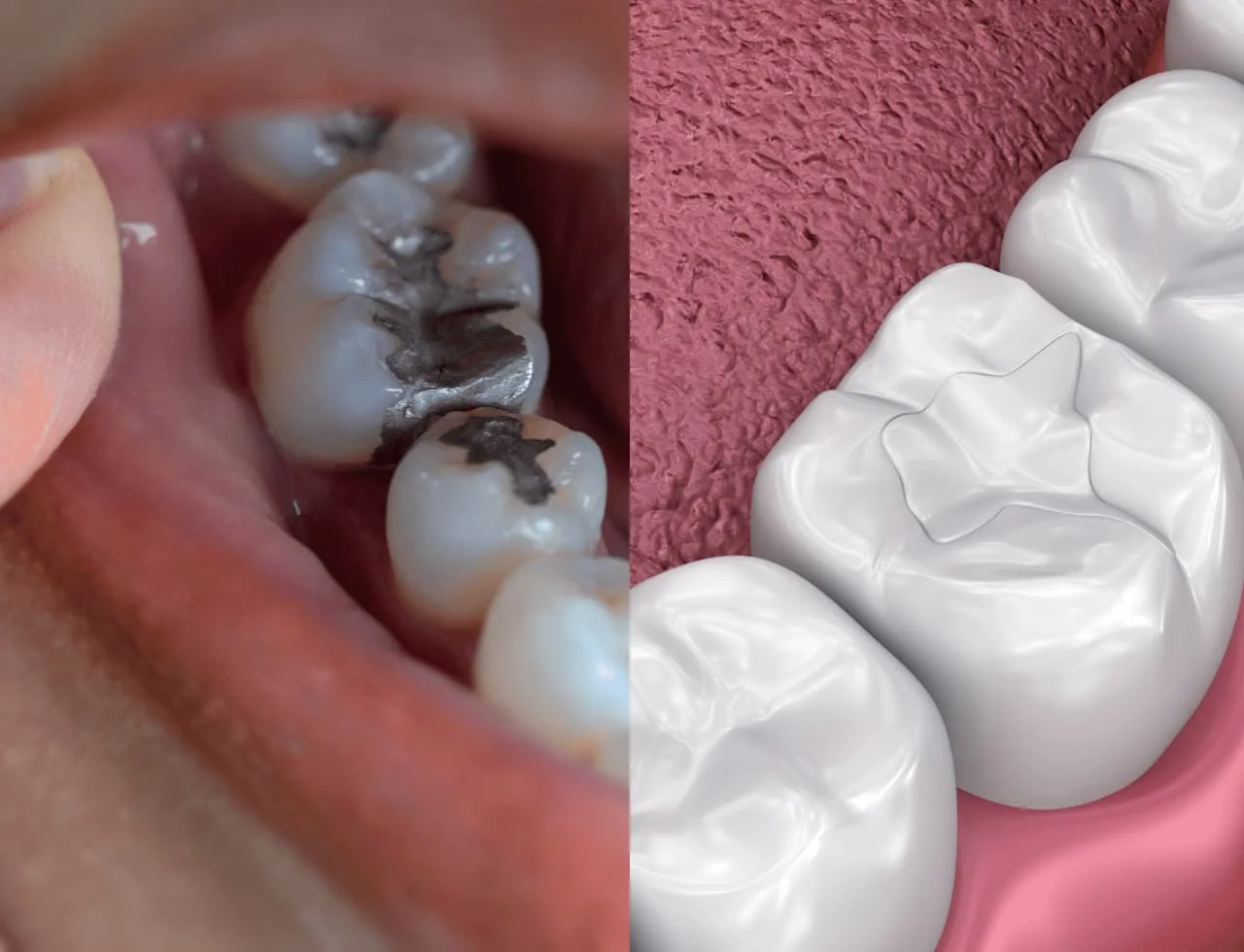 Porcelain & Composite Fillings