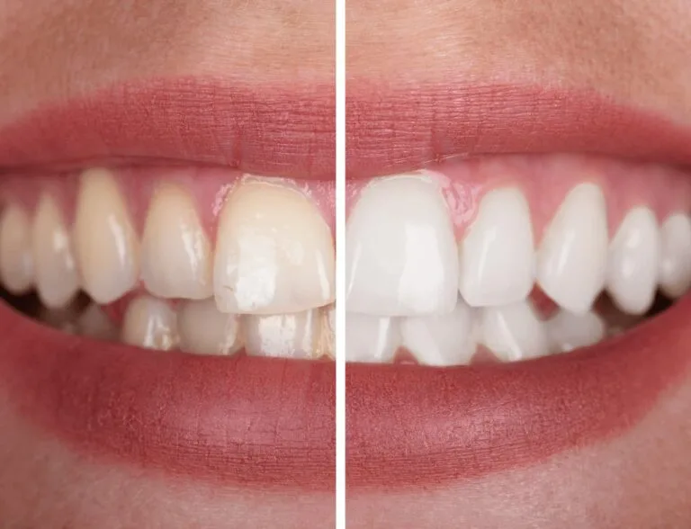 Teeth Whitening at Smilebook Dental Hyderabad