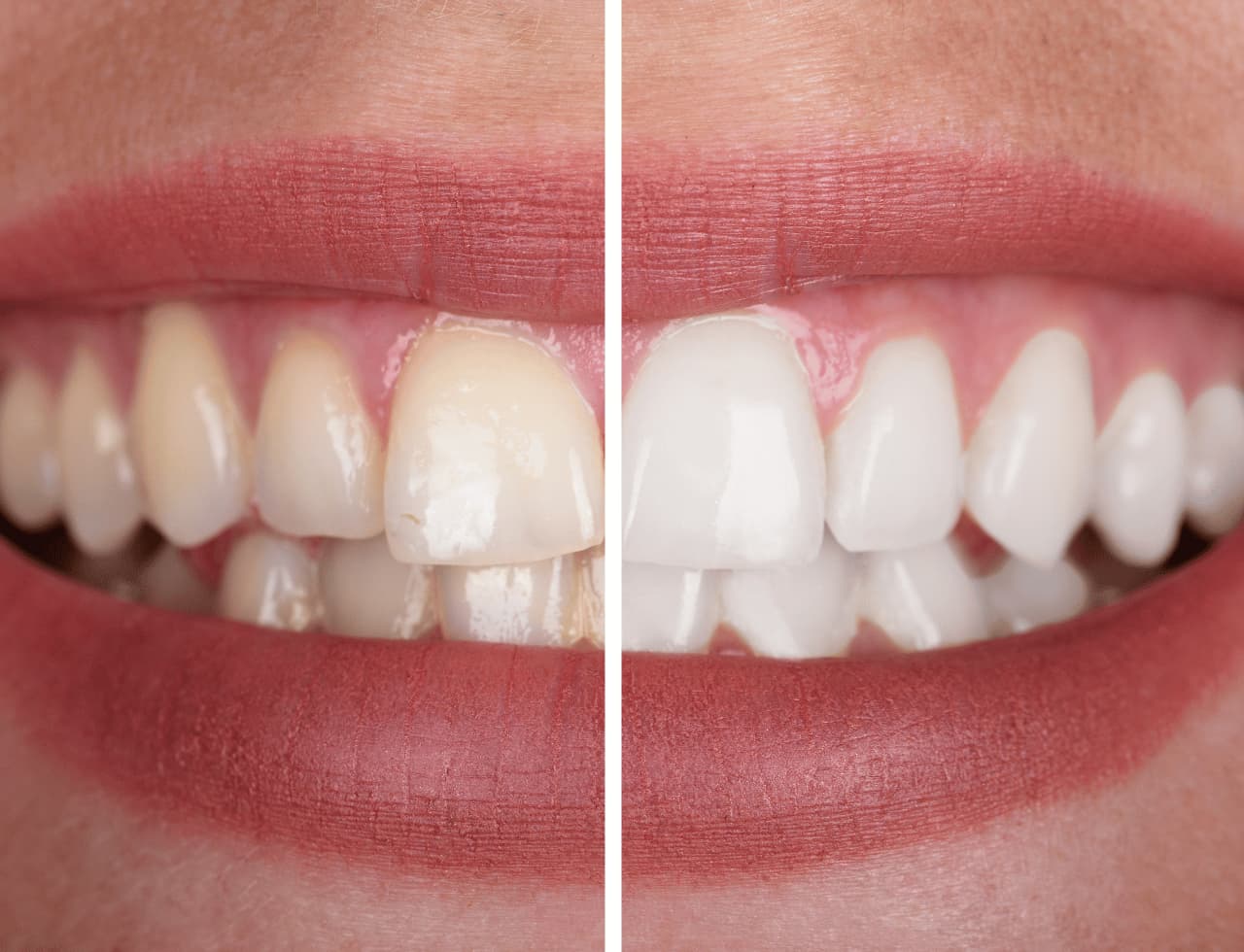 Teeth Whitening at Smilebook Dental Hyderabad