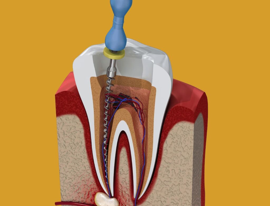 Teeth Cleaning Cost in Hyderabad Smilebook Dental