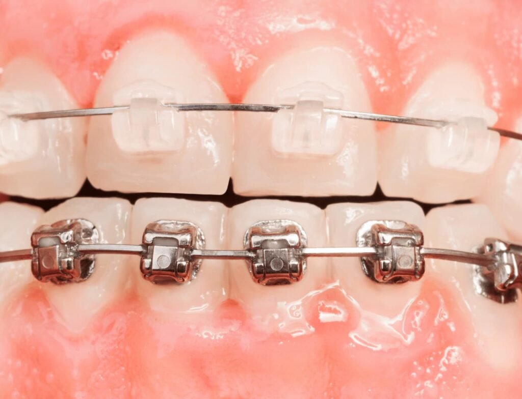 Invisible braces cost in Hyderabad - Smilebook Dental