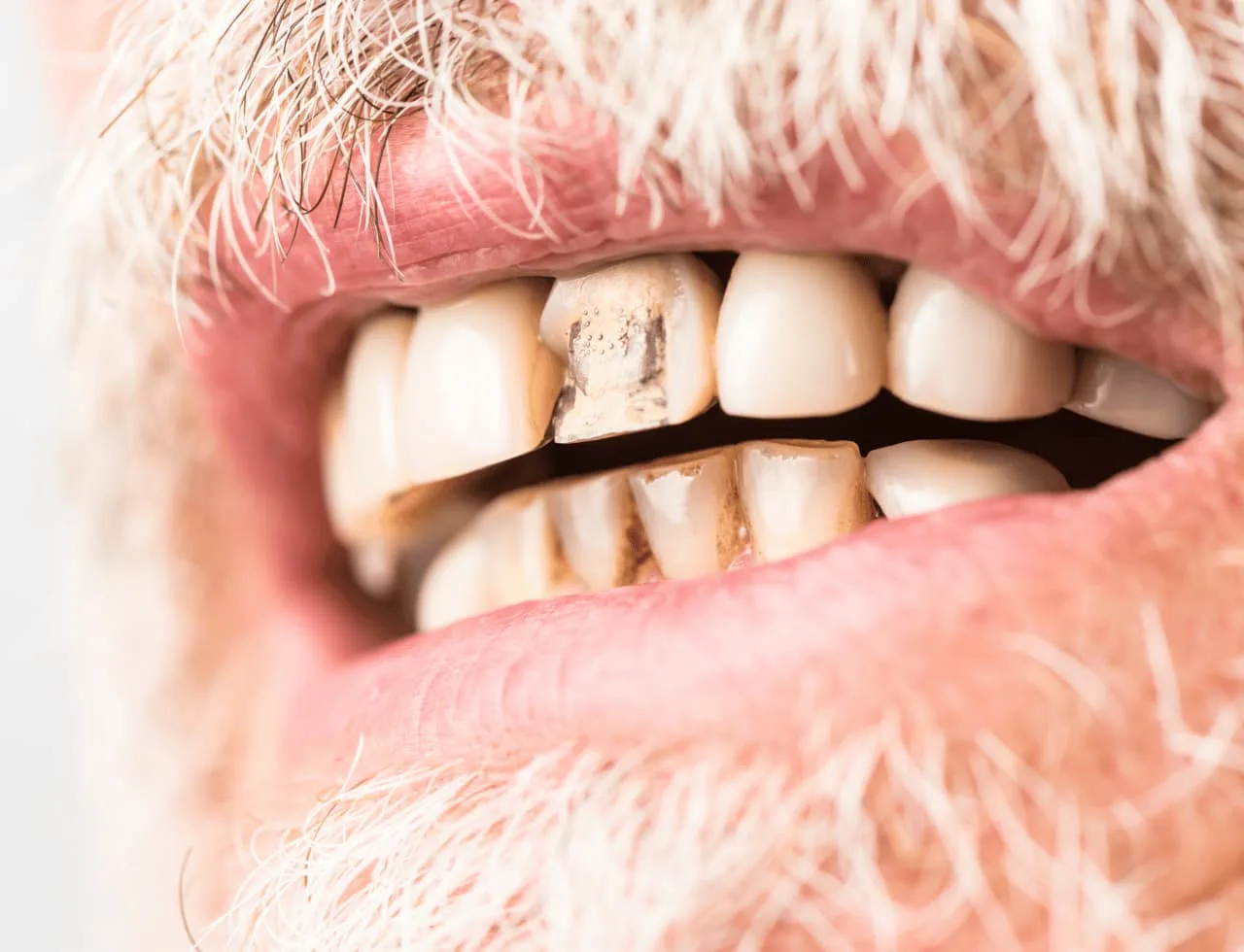 Invisalign for Crowded Teeth