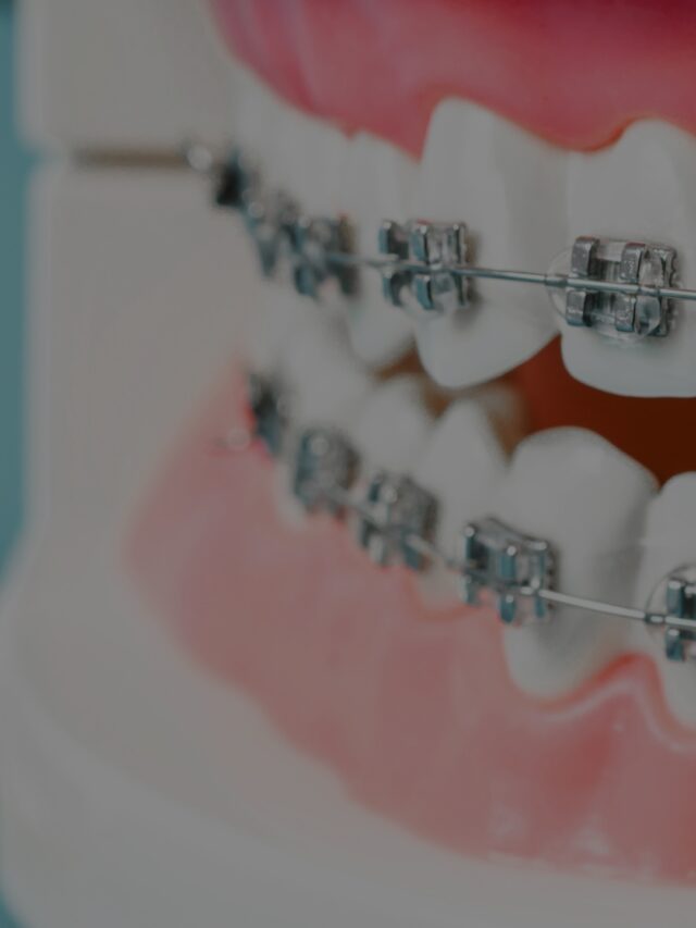 Teeth Braces Types and Cost in Hyderabad will shock you!