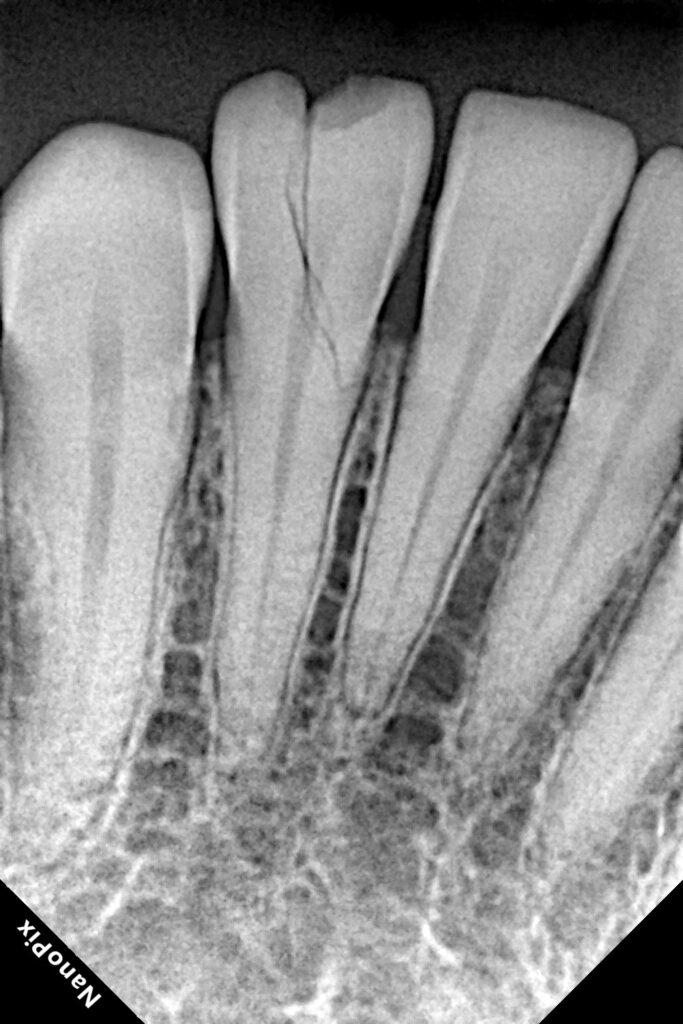 Vertical tooth fracture X-ray diagnosis at smilebook dental BachupallyHyderabad