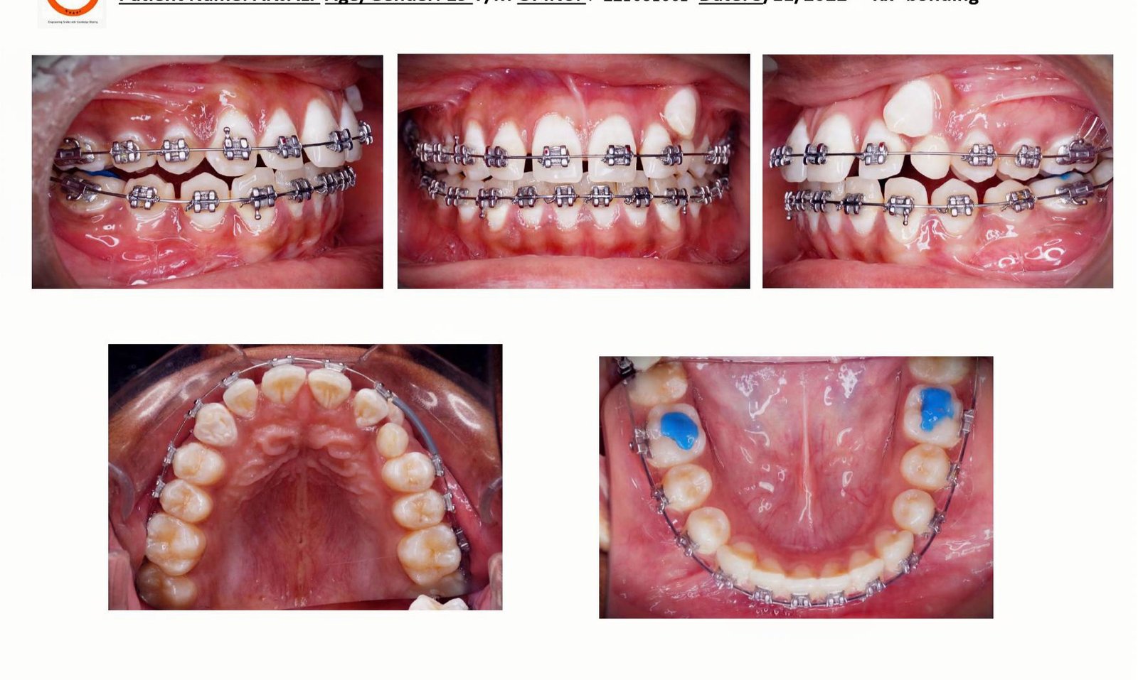 Fixed metal braces bonding case, Smiles by Sneha Gachibowli