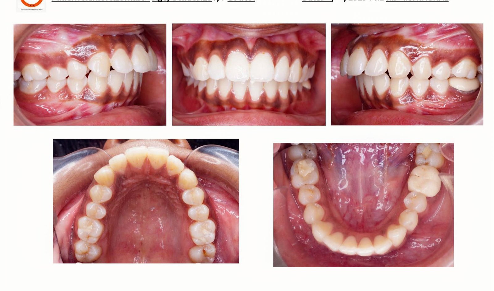 Invisalign before and after case, Smiles by Sneha Gachibowli