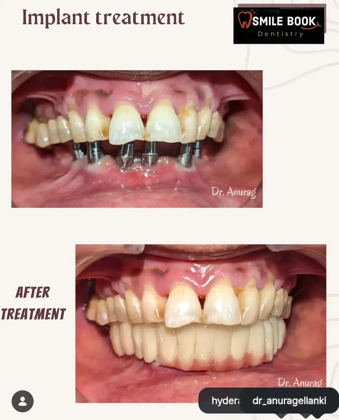 Dental implant before and after case by Dr. Anurag Ellanki, Smilebook Dental