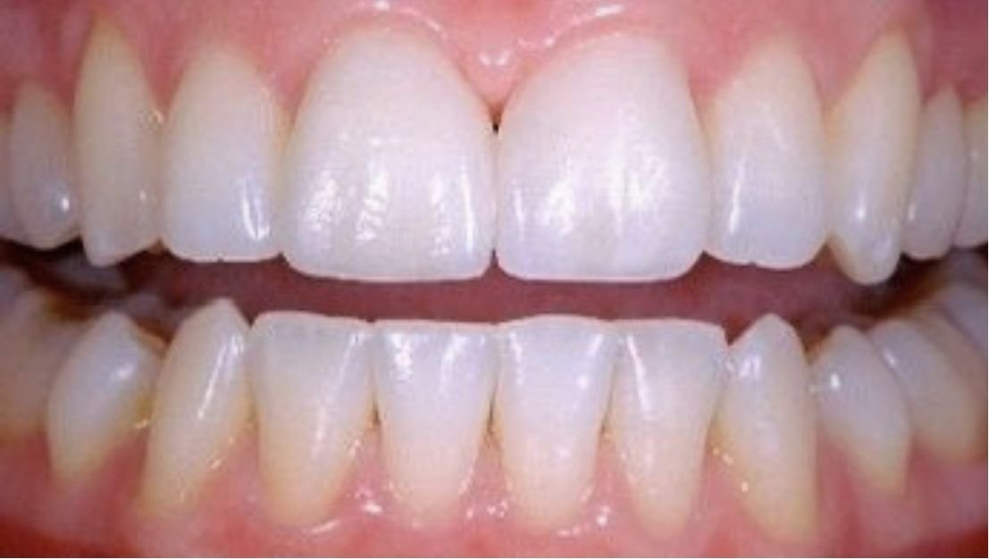 Gap between front teeth before Invisalign at Smiles by Sneha Gachibowli