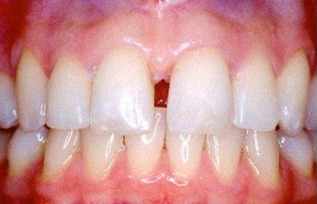 Front gap closed after Invisalign Moderate at Smiles by Sneha Gachibowli