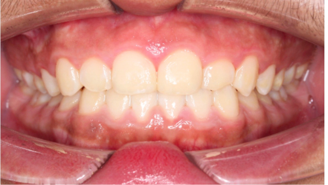 Crossbite before Invisalign Full at Smiles by Sneha Gachibowli