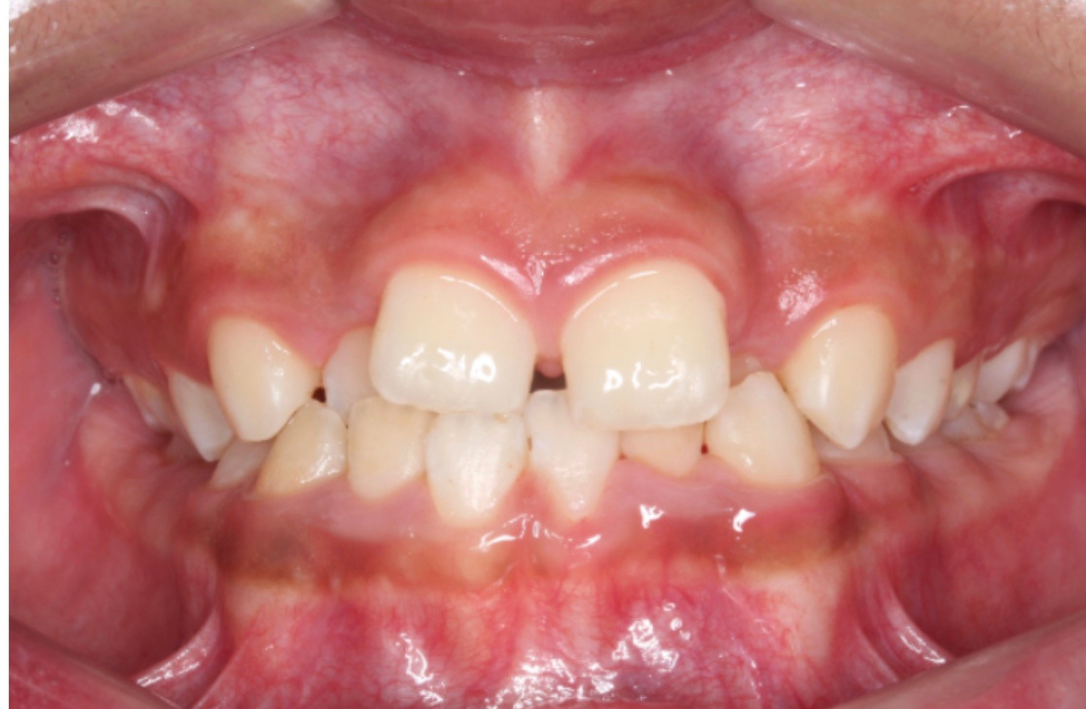 Crossbite corrected after Invisalign at Smiles by Sneha Gachibowli