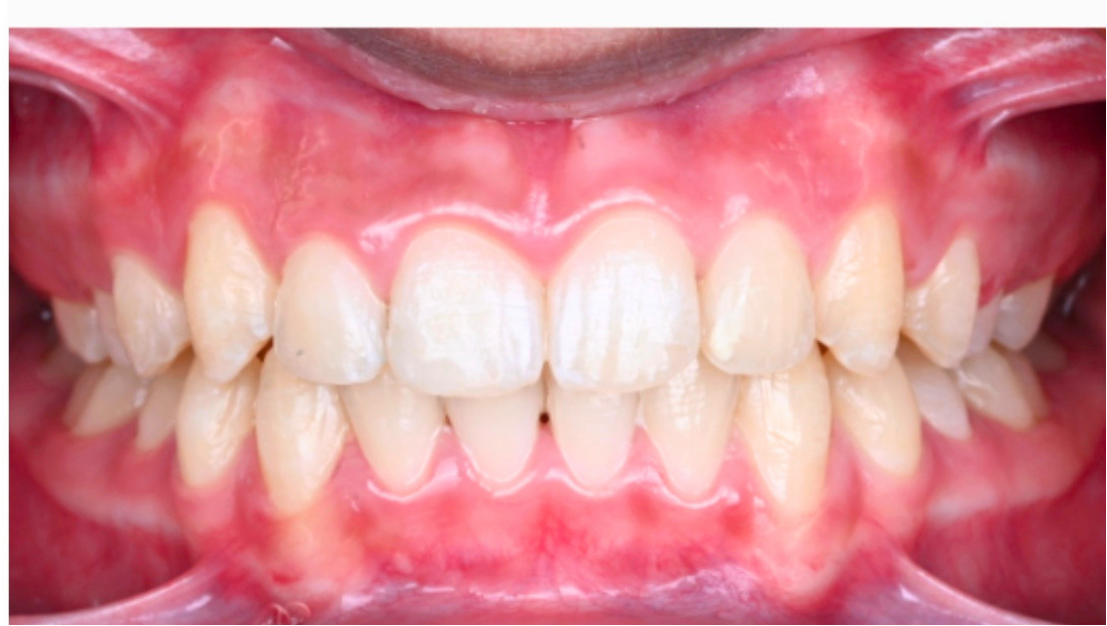 Deep overbite before Invisalign Full at Smiles by Sneha Gachibowli