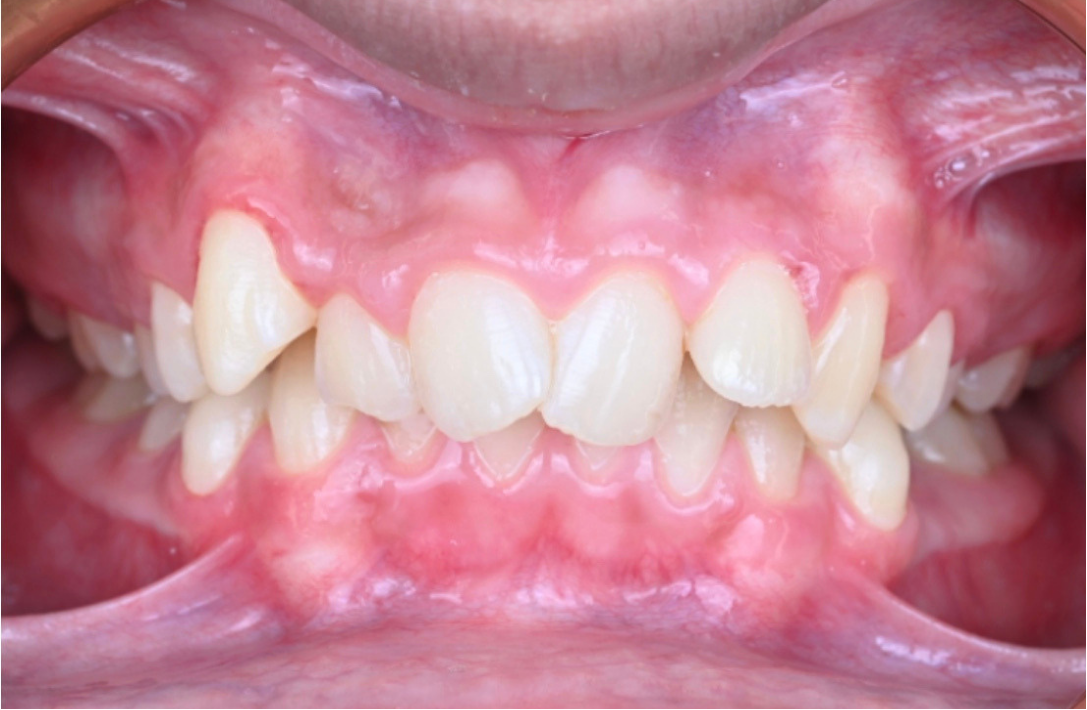 Overbite corrected after Invisalign Full at Smiles by Sneha Gachibowli