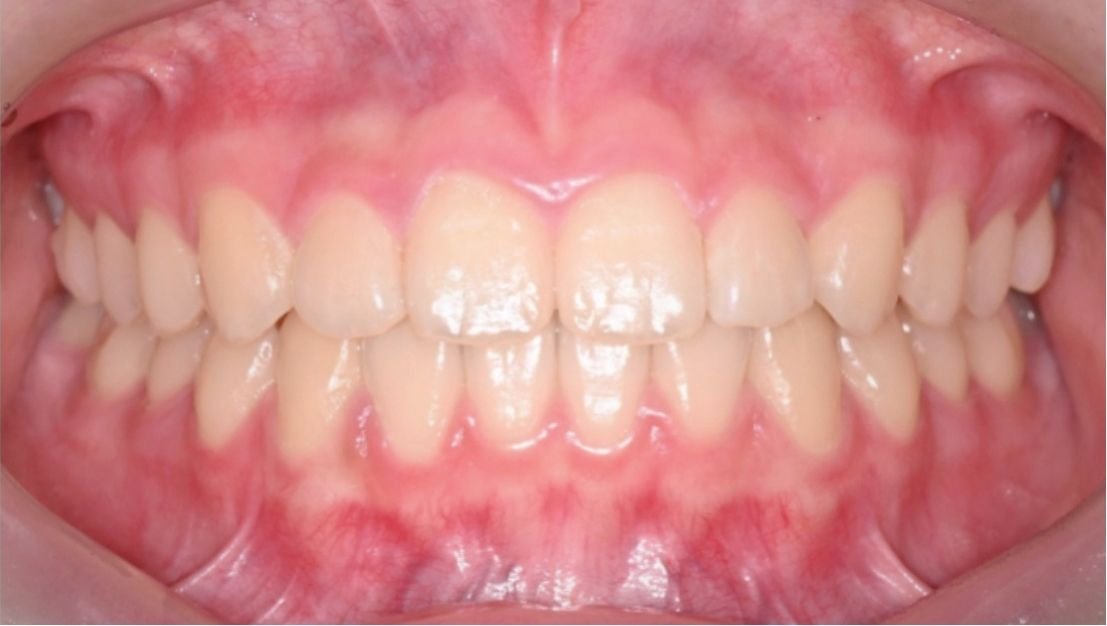 Mild crowded teeth before Invisalign Lite at Smiles by Sneha Gachibowli