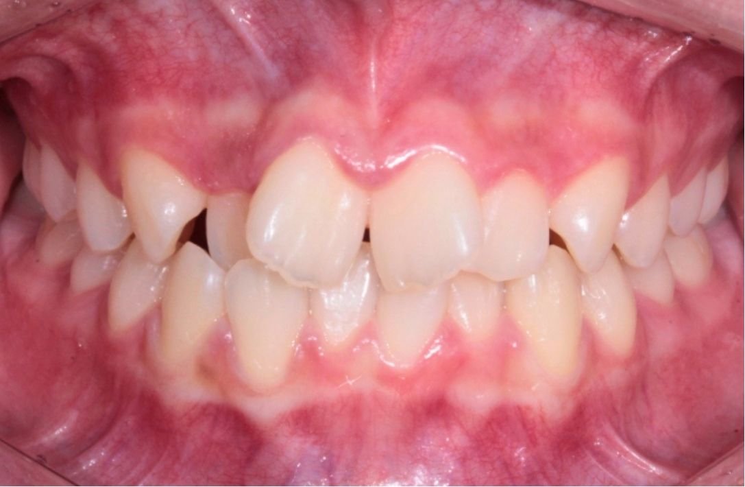 Mild crowding corrected after Invisalign Lite at Smiles by Sneha Gachibowli