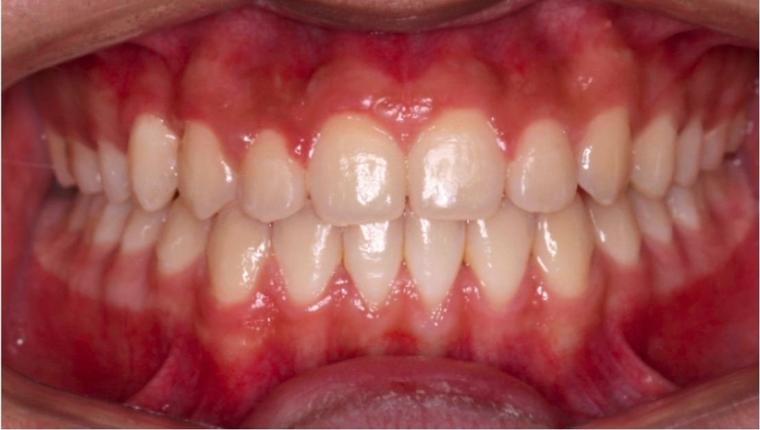 Multiple gaps between teeth before Invisalign at Smiles by Sneha Gachibowli