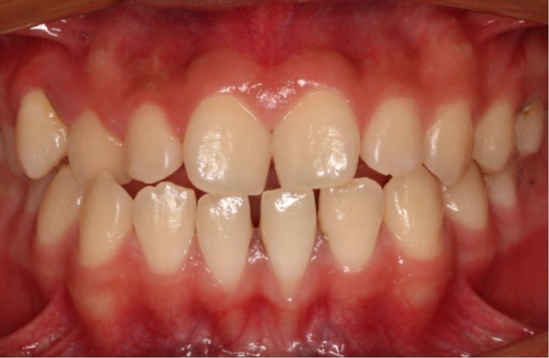 Multiple gaps closed after Invisalign Moderate at Smiles by Sneha Gachibowli