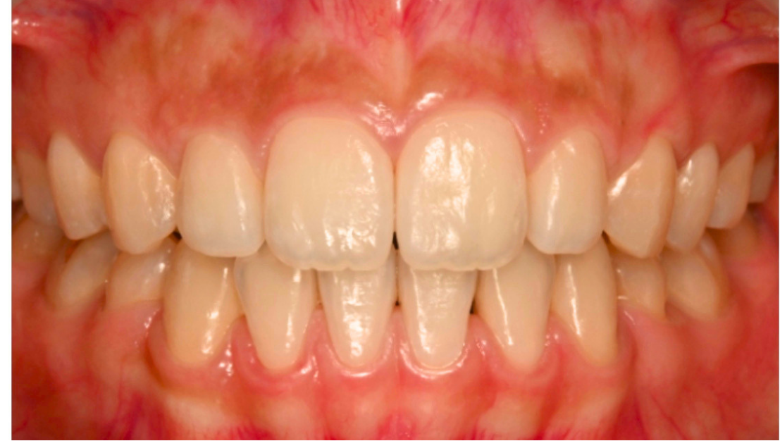 Severely crowded teeth before Invisalign treatment at Smiles by Sneha Gachibowli