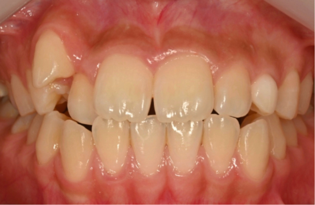 Crowded teeth perfectly aligned after Invisalign Full at Smiles by Sneha Gachibowli